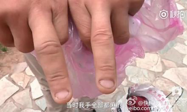 男子手部和臉部不同程度被炸傷。